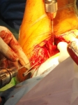 9. OSTEOSÍNTESIS TRAS OSTEOTOMÍA PERIACETABULAR