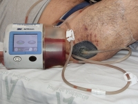 14. TERAPIA VAC EN ABCESO MORELL-LAVALÉ
